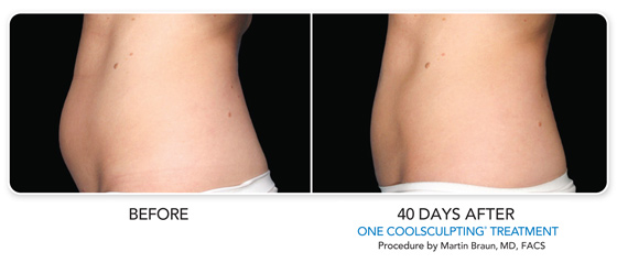 CoolSculpting Before After Images-1, Allura Skin & Laser Center, San Mateo
