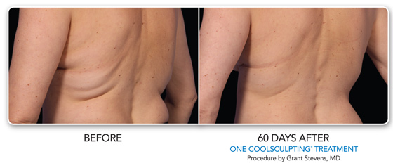 CoolSculpting for Bra Fat, Bra Bulge, Armpit & Back Bra Fat