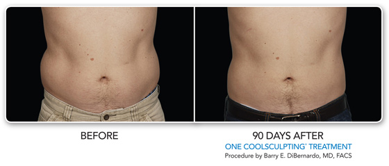 CoolSculpting Before After Images-3, Allura Skin & Laser Center, San Mateo