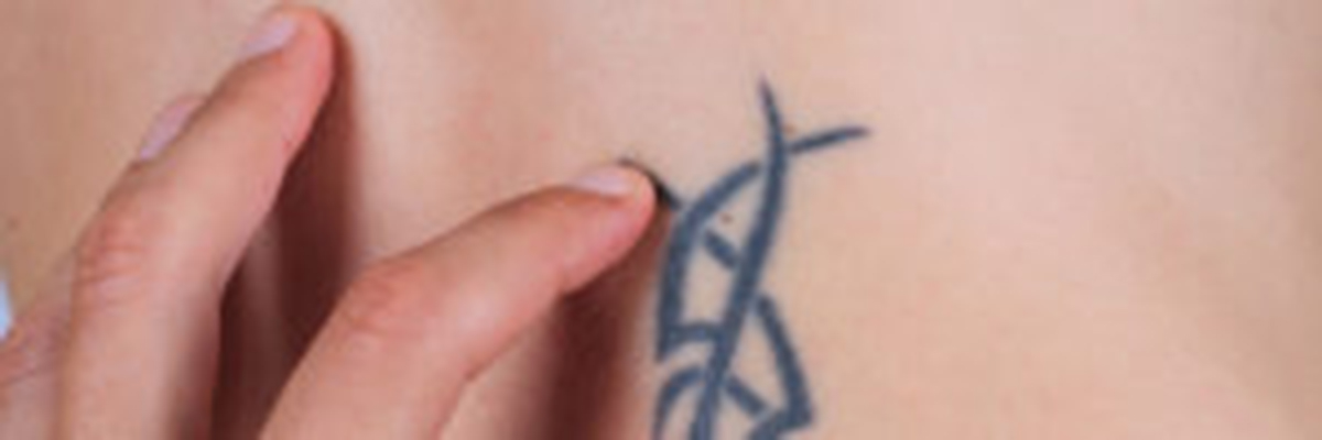 laser-tattoo-removal-treatment-in-san-mateo-ca