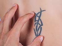 Tired of that tattoo? Dermatologist in San Mateo, CA offers laser tattoo removal