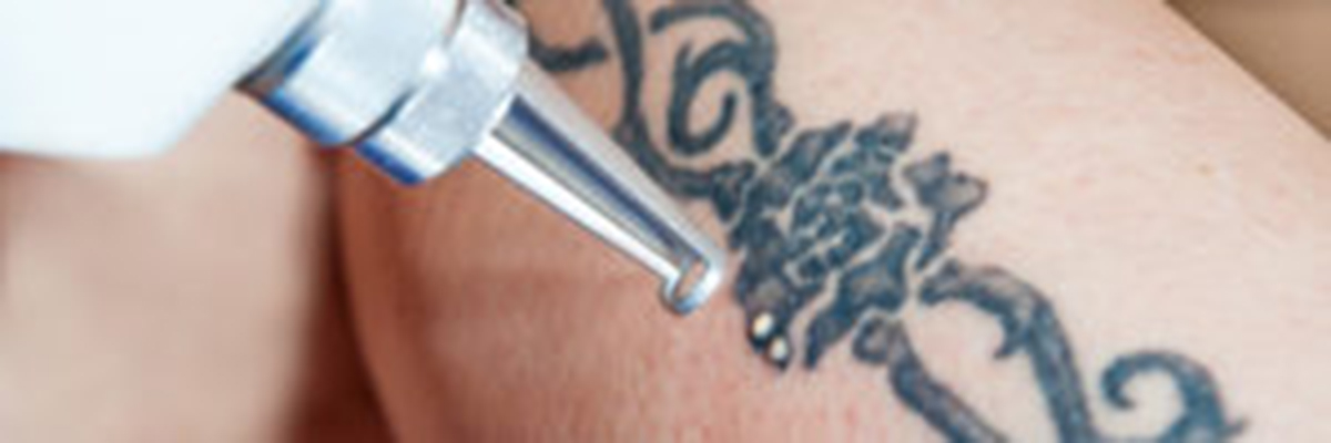 Tattoo Removal Services San Mateo CA area