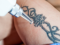 San Mateo, CA professional offers laser tattoo removal for any skin type and ethnicity
