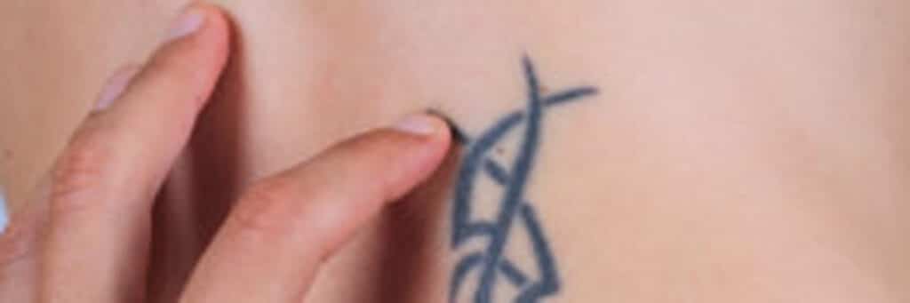 laser-tattoo-removal-treatment-in-san-mateo-ca