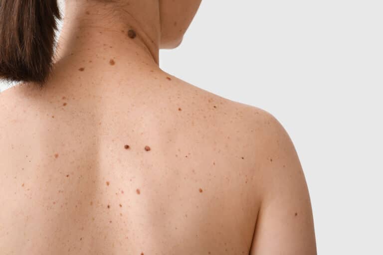 A woman with lots of moles