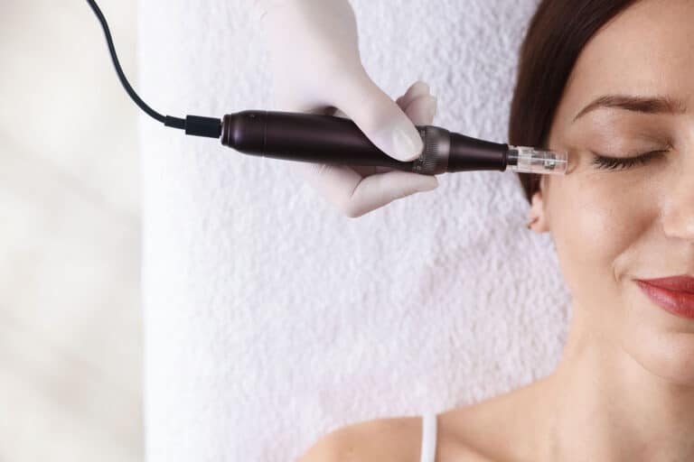 Microneedling and Chemical Peel