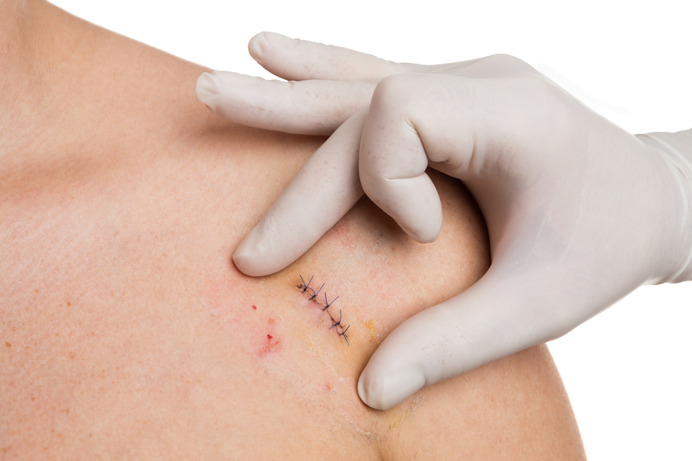 A person's hand measuring wound
