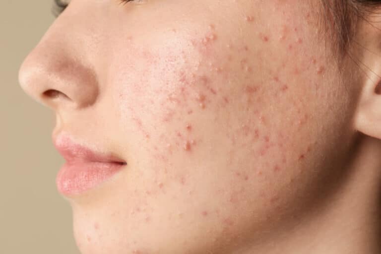 How Does a Facial for Acne-Prone Skin Differ From a Basic Facial?