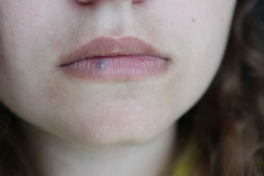 Lip Hemangioma and Venous Lakes: What Are They and What Are Your Options?