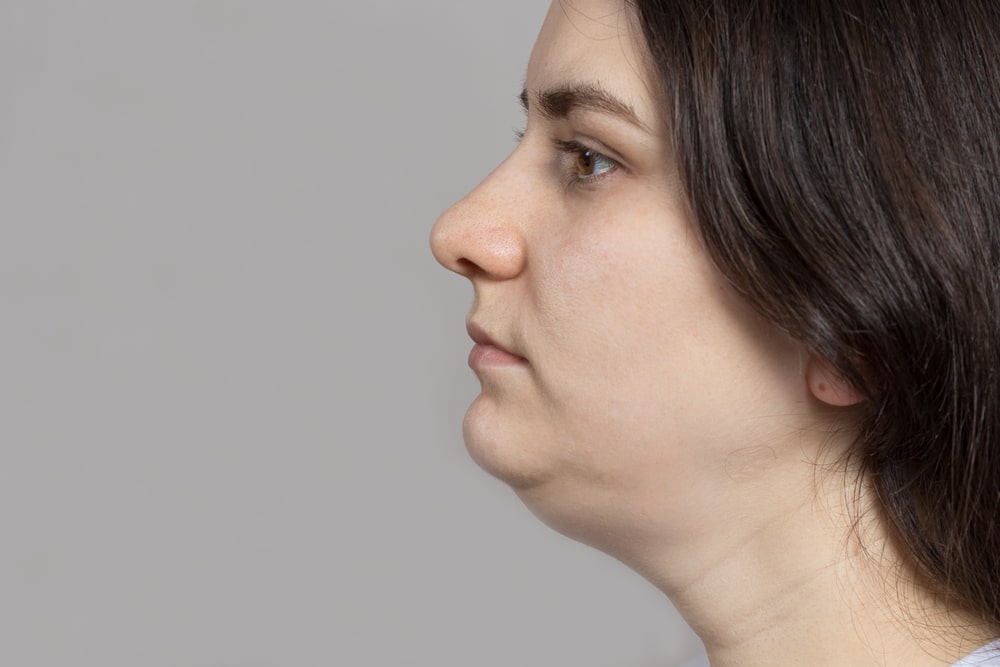 How to Treat a Double Chin