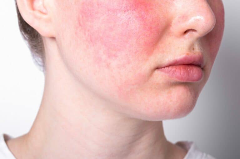 Rosacea