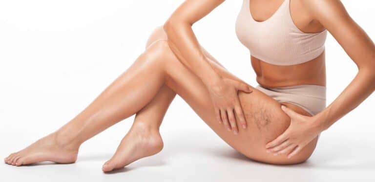 How Sclerotherapy Helps Improve the Appearance of Veins