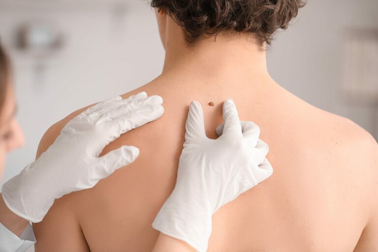 3 Warning Signs of Melanoma Dermatologists Wish You Knew and Didn't Ignore