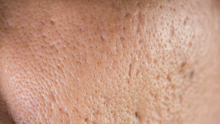 What Is the Best Treatment for Acne Scars?