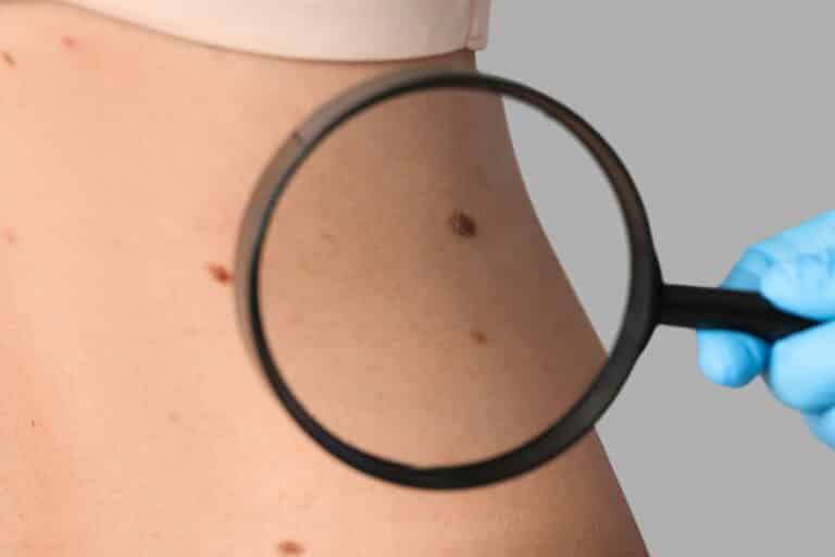 Critical Signs of Skin Cancer You Shouldn't Ignore