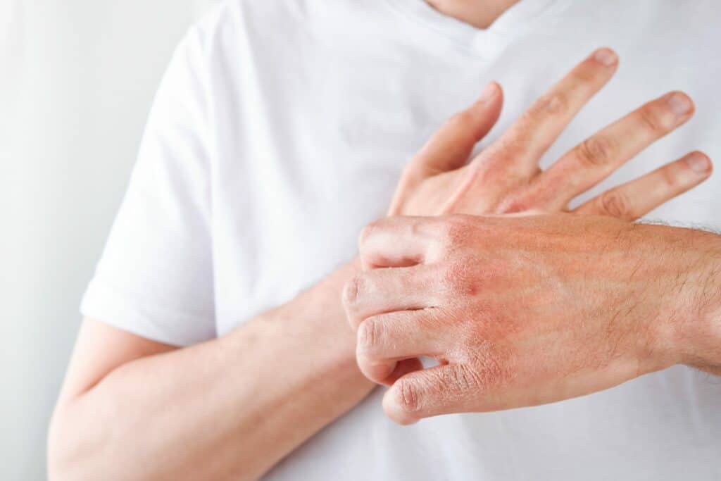 7 Natural Remedies for Eczema to Try