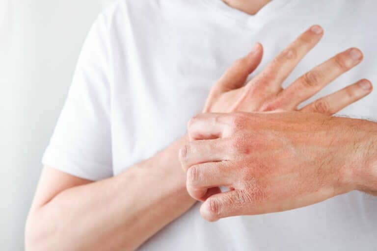 7 Natural Remedies for Eczema to Try